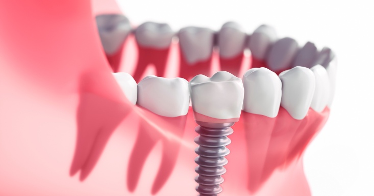Can You Get Dental Implants if You Have Gum Disease?